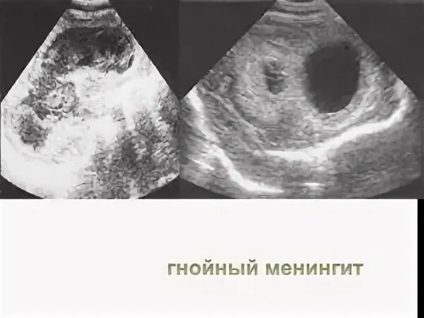 Менингоэнцефалит, воспаление головного мозга. Асептический серозный менингит. Риногенный менингит. Риногенный абсцесс мозга этиология. Вторичный гнойный менингит классификация.