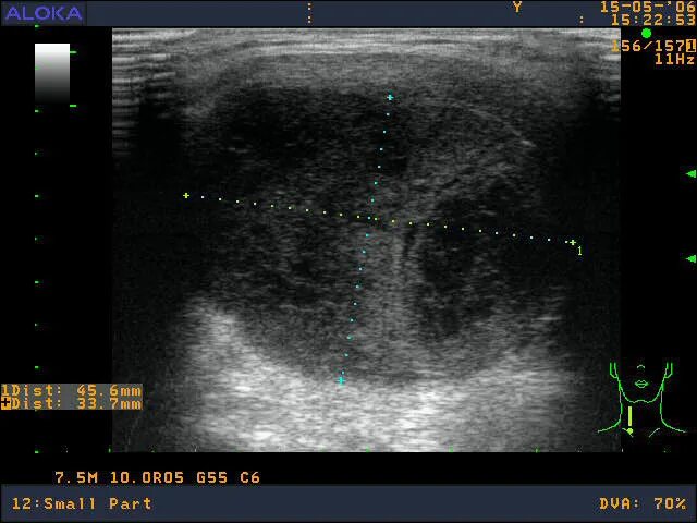 кальцинат щитовидной железы узи. узел в щитовидной железе 4 мм. губчатый узел щитовидной железы на узи. узловой гипертиреоидный зоб. дтз на узи щитовидной железы.