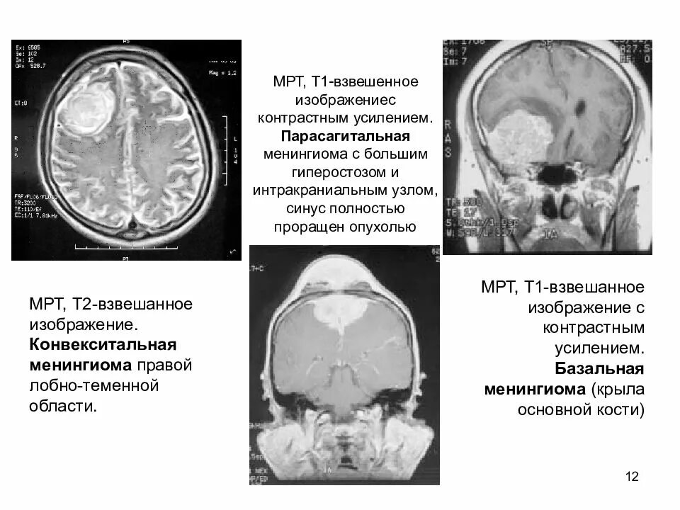 Менингиома лобно-теменной области. Мрт.. Опухоли мозга (менингиома);. Менингиома лобной доли кт. Менингиома лобной области мрт. Опухоли теменной