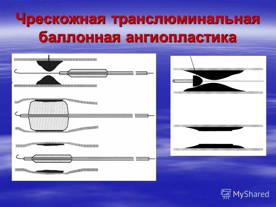 Транслюминальная баллонная ангиопластика