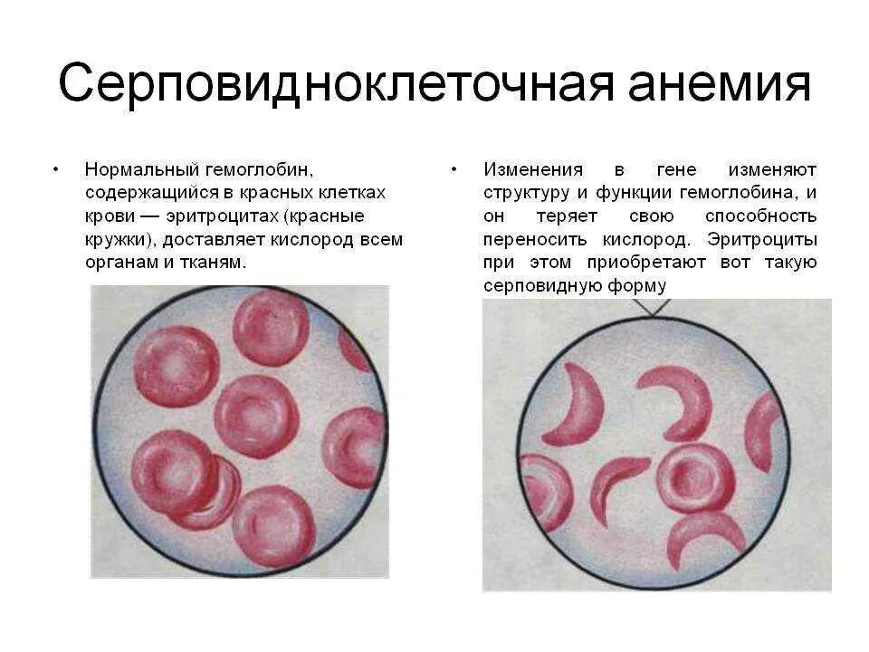 Синдром тельца. Форма эритроцитов при серповидноклеточной анемии. Серповидная анемия эритроциты. Структура гемоглобина при серповидноклеточной анемии. Сероповидно клеточная анемия.