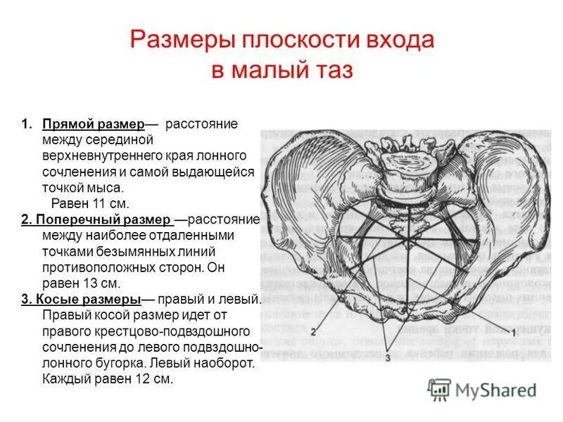 Таблица размеров таза акушерство. Прямой размер плоскости входа в малый таз. Поперечный размер плоскости входа в малый таз. Поперечный размер входа в малый таз. Прямой размер плоскости в малый таз