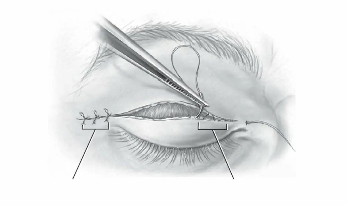 Блефаропластика нижних век швы. Нижняя блефаропластика пинч что это. Блефаропластика верхних век разрез.