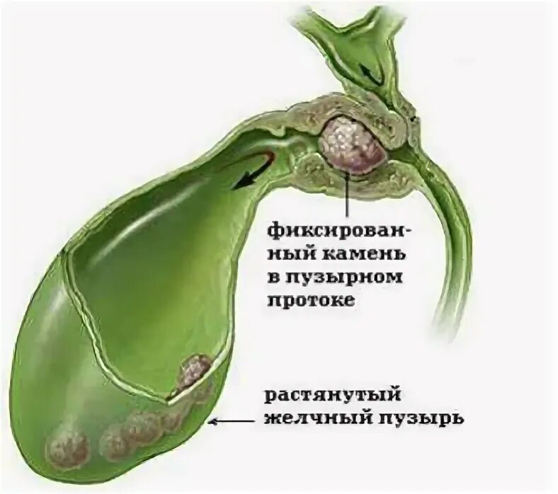Отключенный желчный что делать. Острый холецистит желчного пузыря. Отключенный желчный что делать. Дисформия желчного пузыря. Холедох на узи.