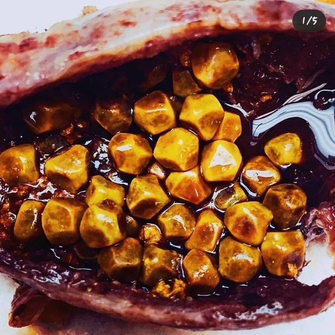 какие желчные камни опаснее. классификация камней при жкб. желчекаменная болезнь холестериновые камни. желчнокаменная болезнь пигментные камни. билирубиновые камни в желчном.