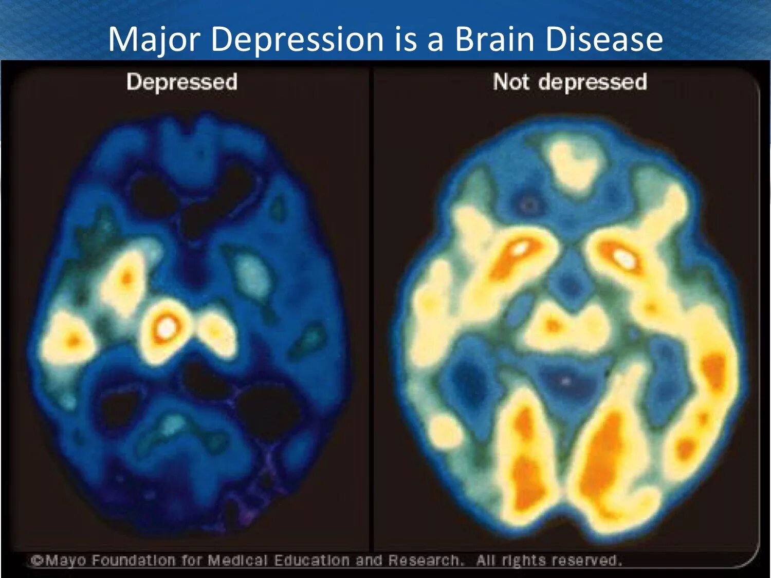 Депрессия головного мозга. Снимки мозга при депрессии. Активность мозга. Мозг при депрессии на томографе. Активность мозга человека в депрессии.