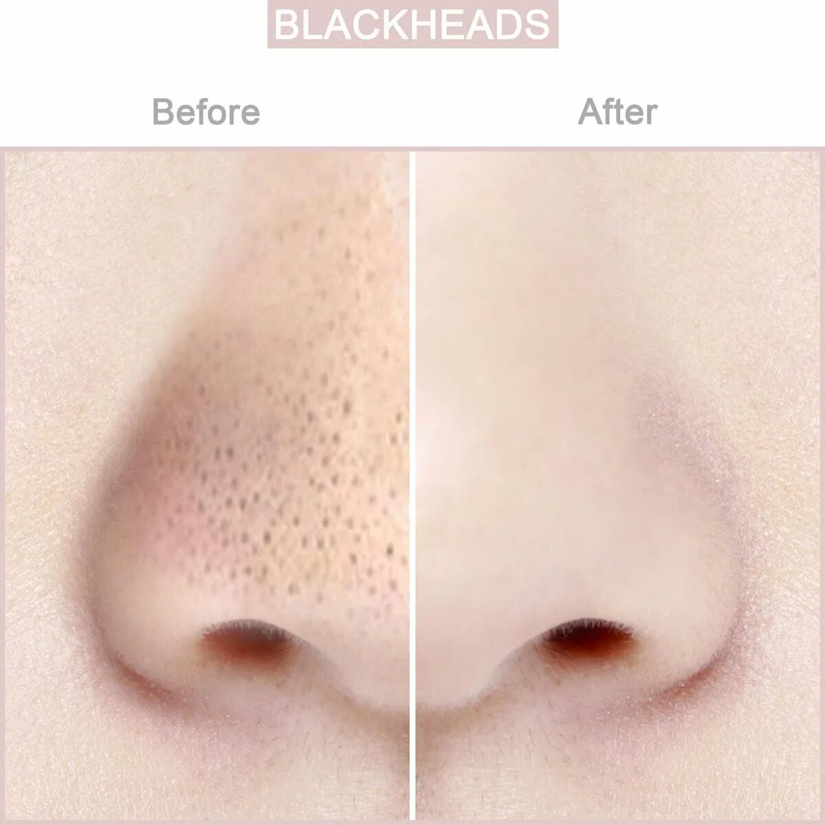 Blackhead remover перевод