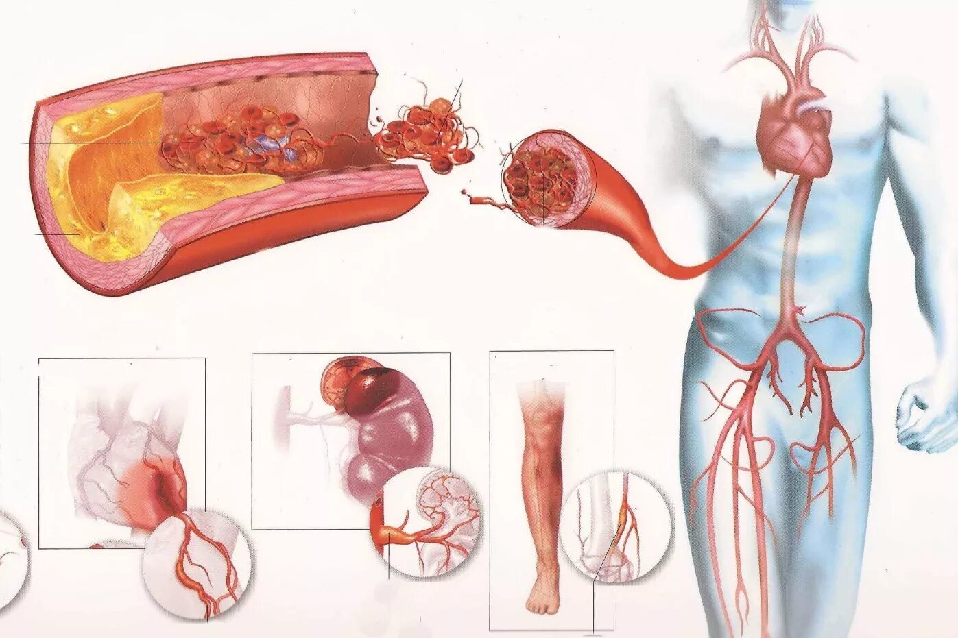Чистка тромба. Заболевания кровеносных сосудов. Атеросклеротические бляшки в сосудах. Атеросклеротическое поражение сосудов.