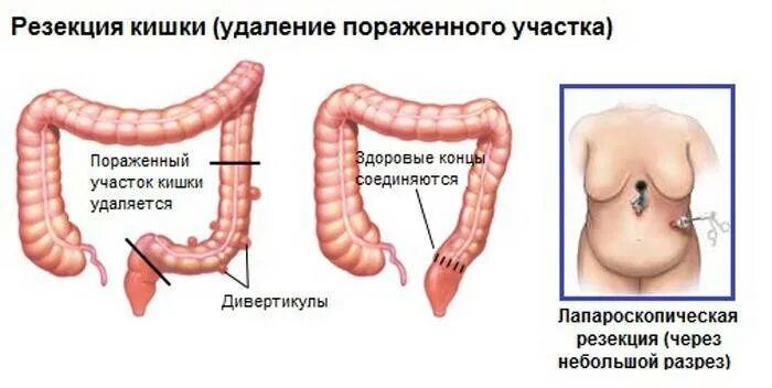 Симптомы операция кишечнике. Дивертикулит сигмовидной ободочной кишки. Резекция сигмовидной кишки схема операции. Дивертикулярная болезнь ободочной кишки симптомы. Дивертикулез ободочной кишки хирургия.