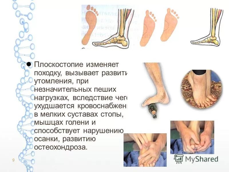 Как поменять походку. Изменение походки при плоскостопии. Правильная походка для мужчин. Изменение походки. Правильная мужская походка.