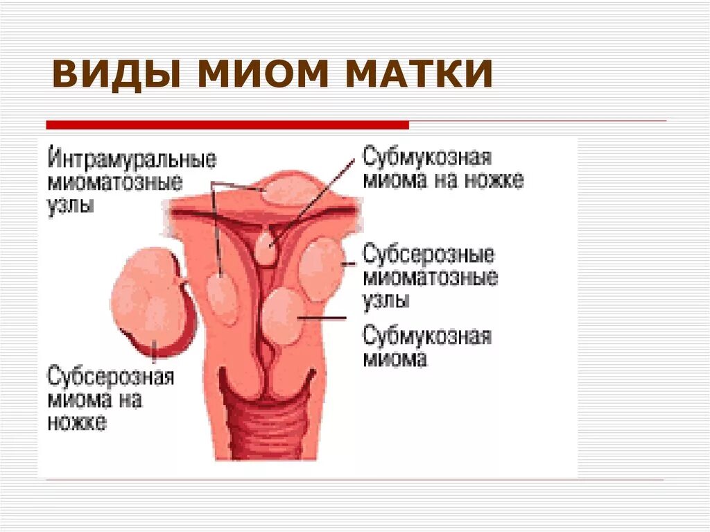 Формы миомы матки. Миома интрамуральный узел. Интрамурально субсерозная лейомиома матки что это. Субмукозная миома матки.