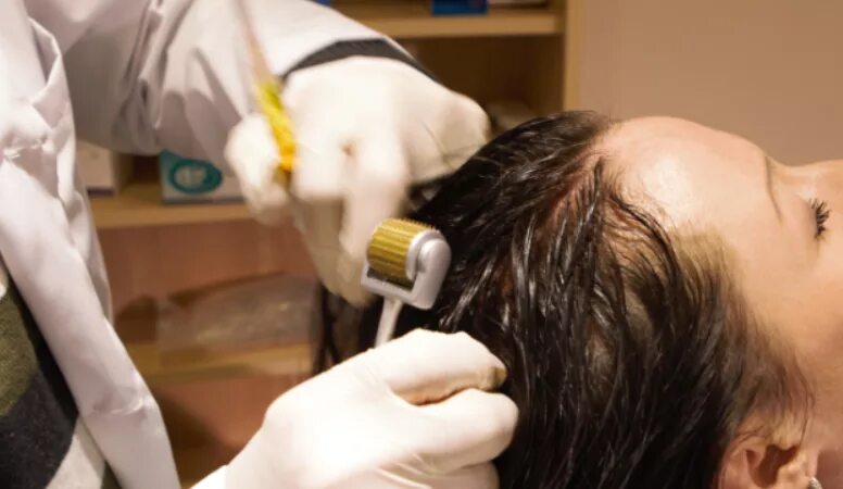Инъекции головы. Мезотерапия волосистой части головы. Мезотерапия для волос мезороллером. Dermaroller для волос. Фракционная мезотерапия кожи головы.