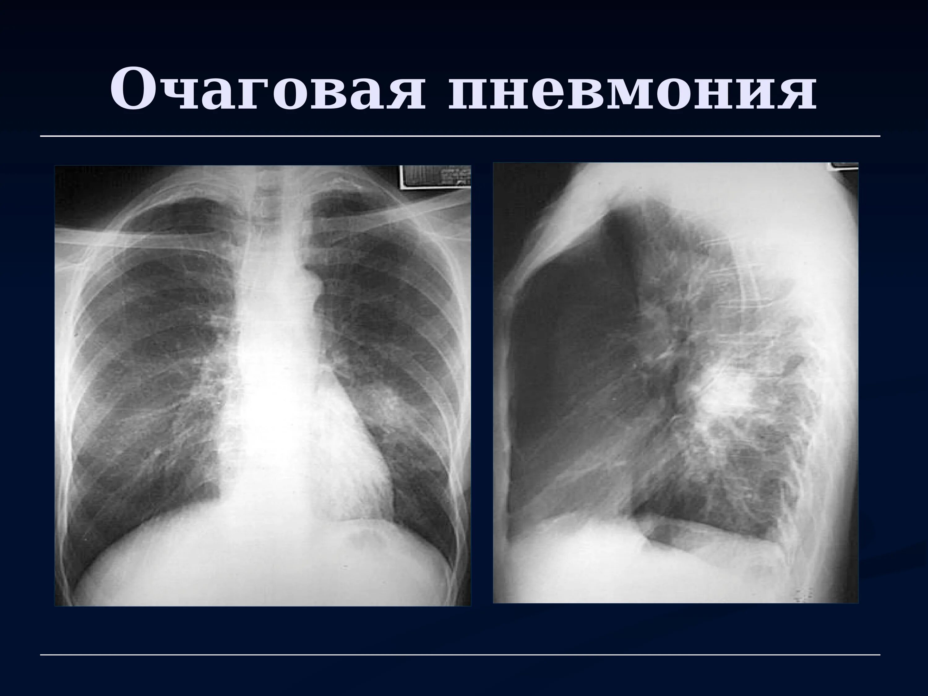 Правосторонняя очаговая пневмония рентген. Очаговая пневмония рентген. Рентген лёгких очаговая пневмония. Очаговая бронхопневмония рентген.