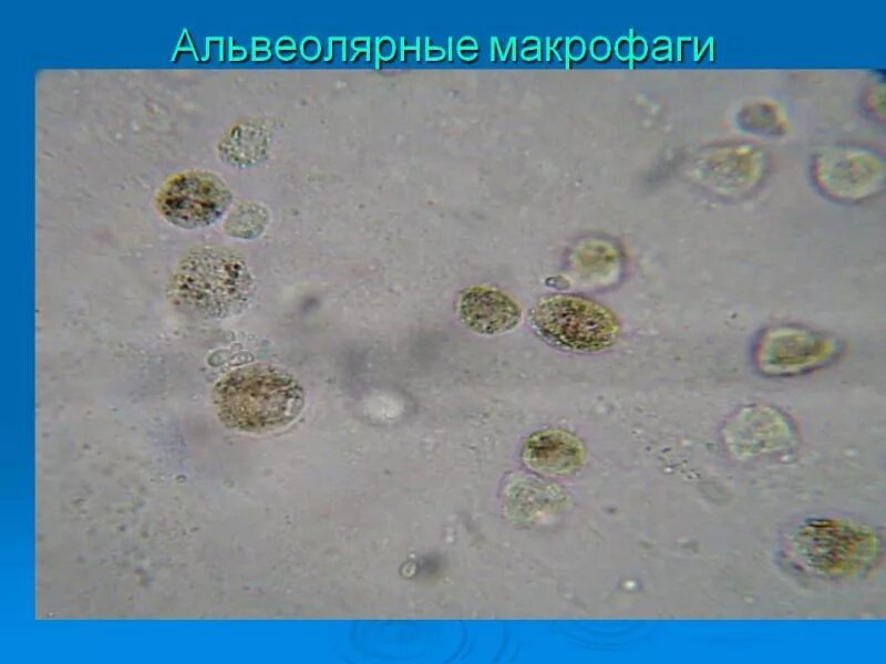 Альвеолярные макрофаги в мокроте микроскопия. Альвеолярные макрофаги в мокроте нативный препарат. Альвеолярные клетки в мокроте нативный препарат. Мокрота нативный препарат микроскопия.