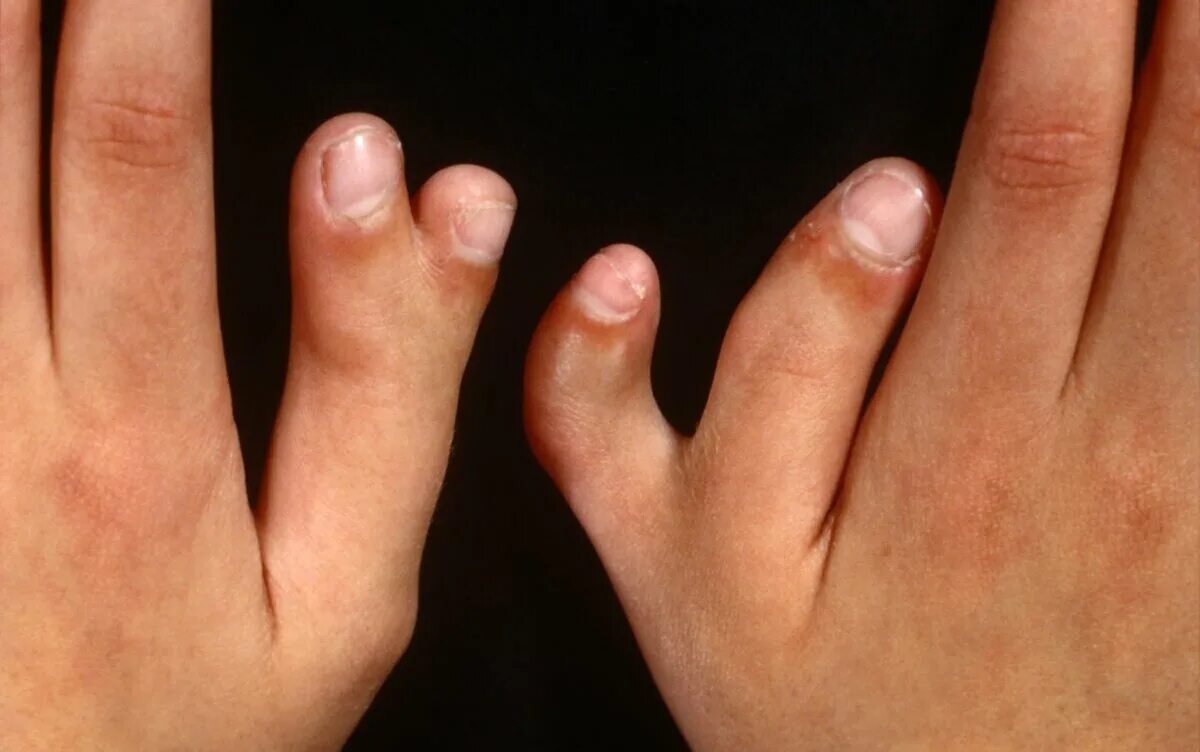 6 пальцев на руках у детей. Постаксиальная полидактилия кистей. Синдром Паллистера холла. Полидактилия генная мутация. Наследственная синдактилия.