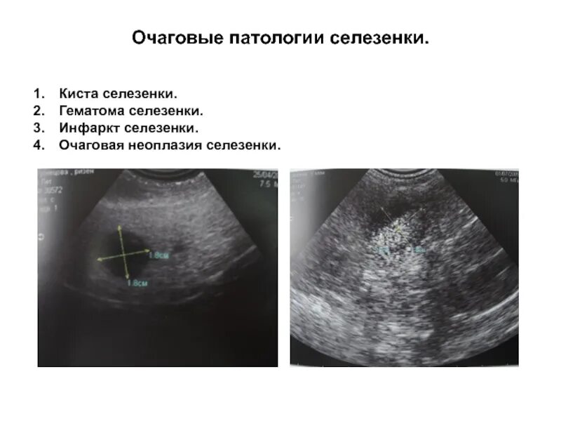 Патология селезенки. Гематома селезенки на УЗИ. Субкапсулярная киста селезенки. Добавочная долька селезенки на УЗИ.