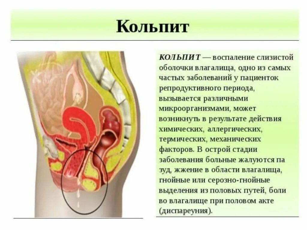 Кольпит при беременности 3 триместр. Трихомонадный кольпит выделения. кольпит клинические проявления. гинекологические заболевания кольпит.