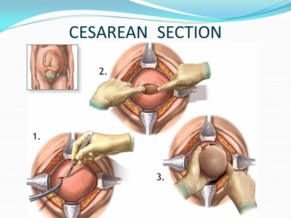 Операция по подтяжке матки. Надрез матки при родах. Операция кесарева сечения.