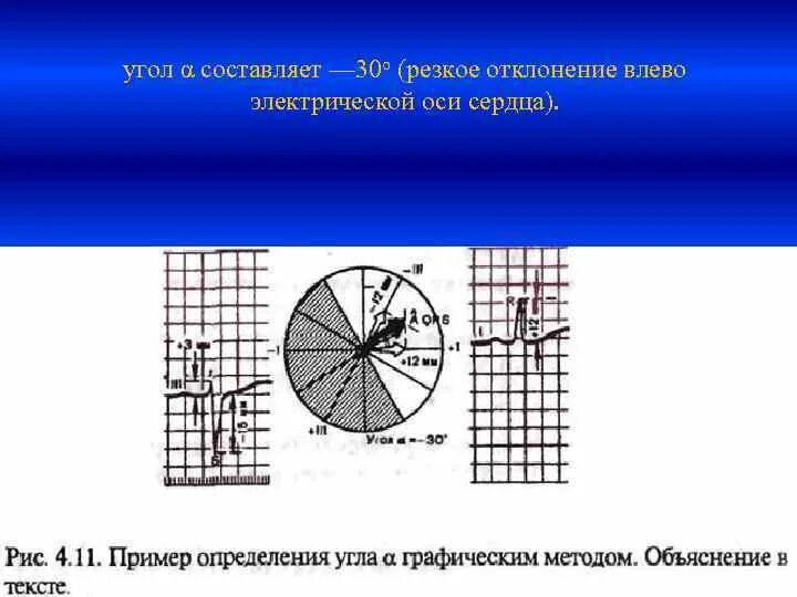 Сердце отклонено вправо. Отклонение электрической оси сердца влево угол Альфа. Угол Альфа при отклонении электрической оси сердца влево. Угол Альфа отклонение ЭОС. Ось сердца отклонена влево.