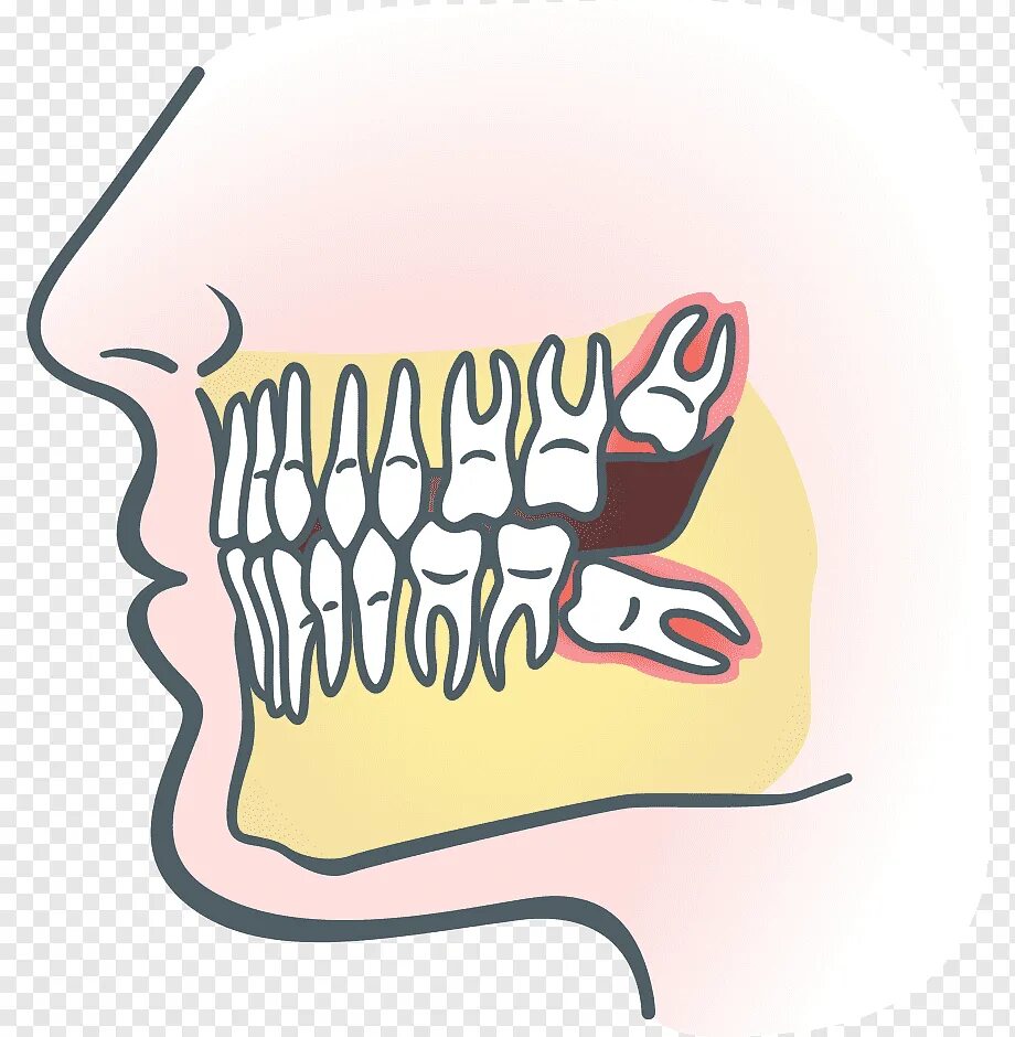 Почему зубы мудрости так называются. Горизонтальный зуб мудрости.