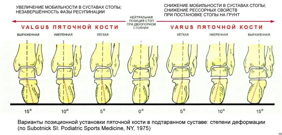 Формы члена бывают. Вальгусная деформация стопы у детей по степеням. Вальгусная деформация голеностопного сустава рентген описание. Вальгусная деформация стопы норма. Классификация вальгусной деформации 1 пальца стопы.