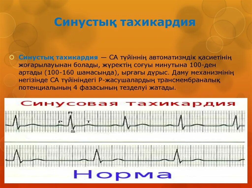 Брадикардия как поднять пульс. Аритмия брадикардия. аритмия и тахикардия. брадикардия на экг. тахикардия и брадикардия.