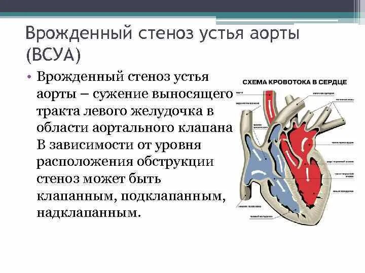 Аортальный стеноз что это такое. Порок сердца стеноз аортального клапана. Аортальный стеноз патогенез кратко. Пороки сердца аортальный стеноз и недостаточность. Аортальный стеноз преднагрузка.