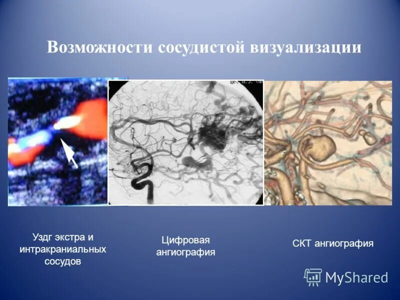 ультразвуковая допплерография сосудов головы. уздг экстра. уздг интракраниальных сосудов. узи уздг бцс. уздг брахиоцефальных сосудов.