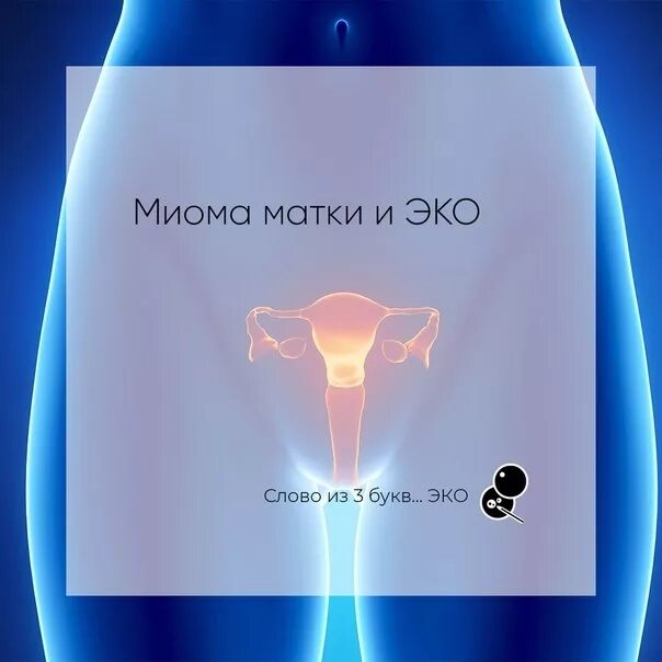 Эко при миоме матки. Эко при миоме матки