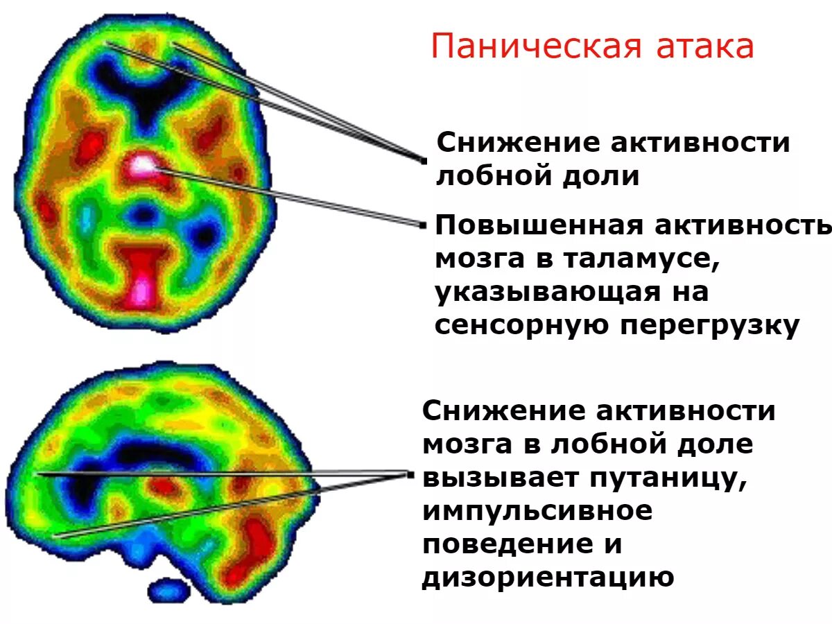 Мозг панические атаки