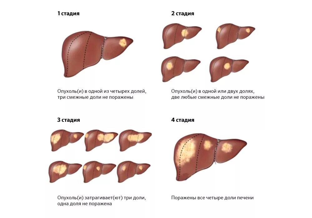 Рак печени стадии прогноз. Цирроз печени стадии развития. Стадии формирования цирроза печени. 2 Стадия цирроза печени симптомы. Цирроза печень опухоли печени.