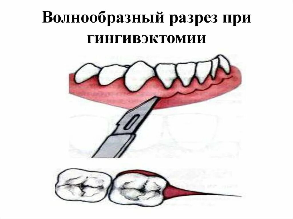 Пластика десны гингивэктомия. Гингивоэктомия. Показания к простой гингивэктомии. Гингивэктомия при пародонтите. Гингивоэктомия.