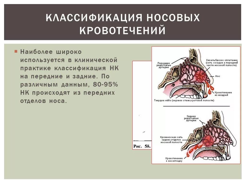 Носовые кровотечения у детей могут возникать. Классификация носовых кровотечений. Носовое кровотечение презентация. Носовое кровотечение этиология. Наиболее частый источник носовых кровотечений.