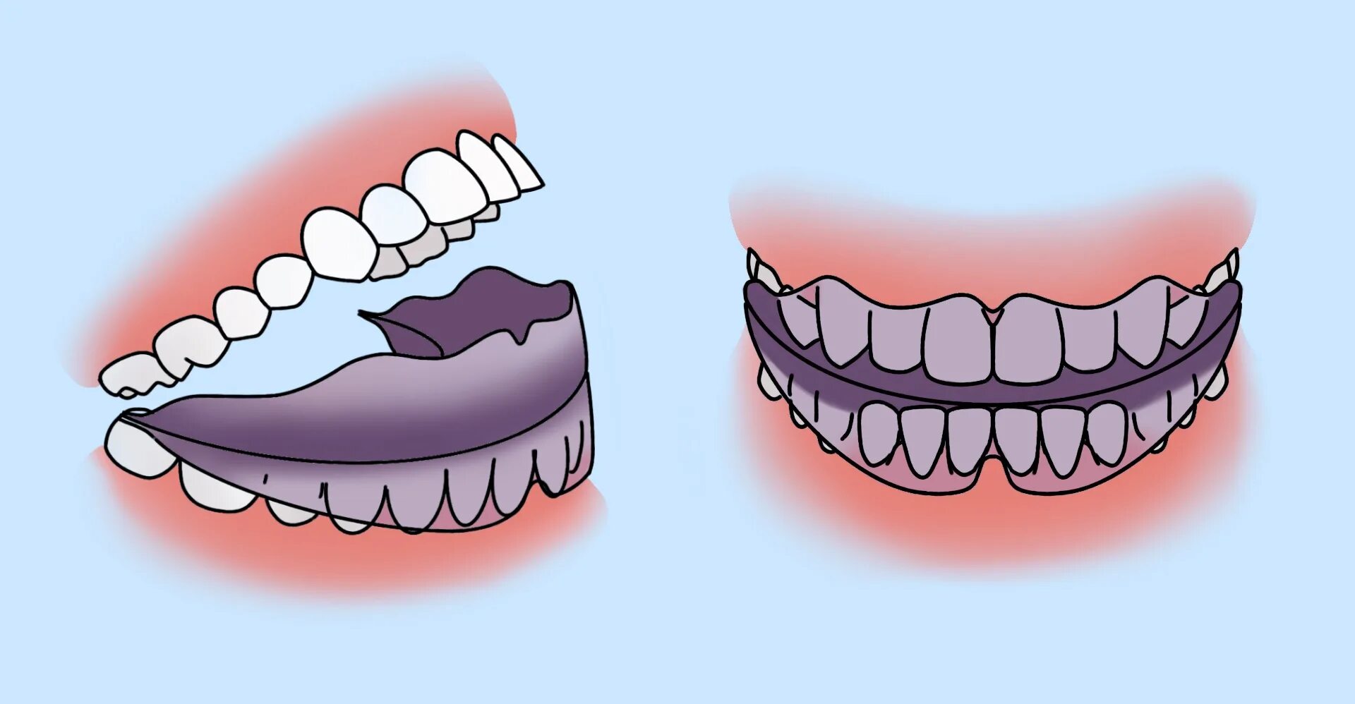 Капы для зубов для бокса. Как правильно одевать челюсть. Миобрейс к2. Одночелюстной ортодонтический аппарат. Полносъемные протезы ортопедическая стоматология.