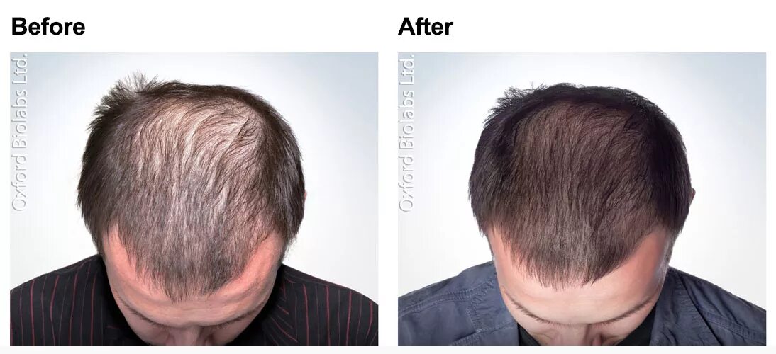 Как ускорить рост волос мужчине на голове. Финастерид миноксидил Результаты. Миноксидил от облысения для мужчин. Миноксидил и финастерид для волос от выпадения.