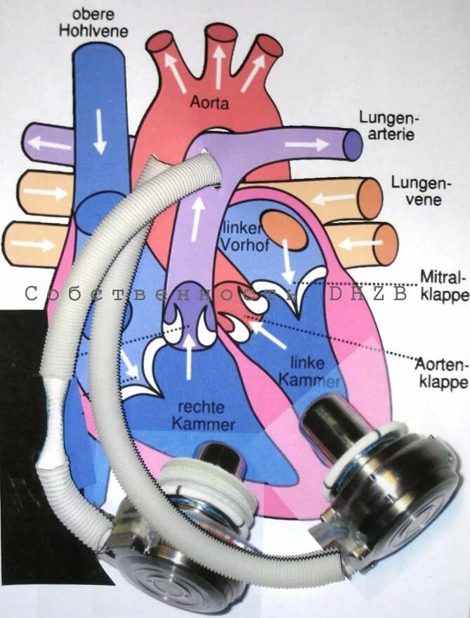 Искусственное сердце. Искусственный желудочек сердца. Искусственное сердце схема. Схема искусственного сердца abiocor.