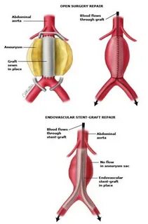 Abdominal aortic aneurysm