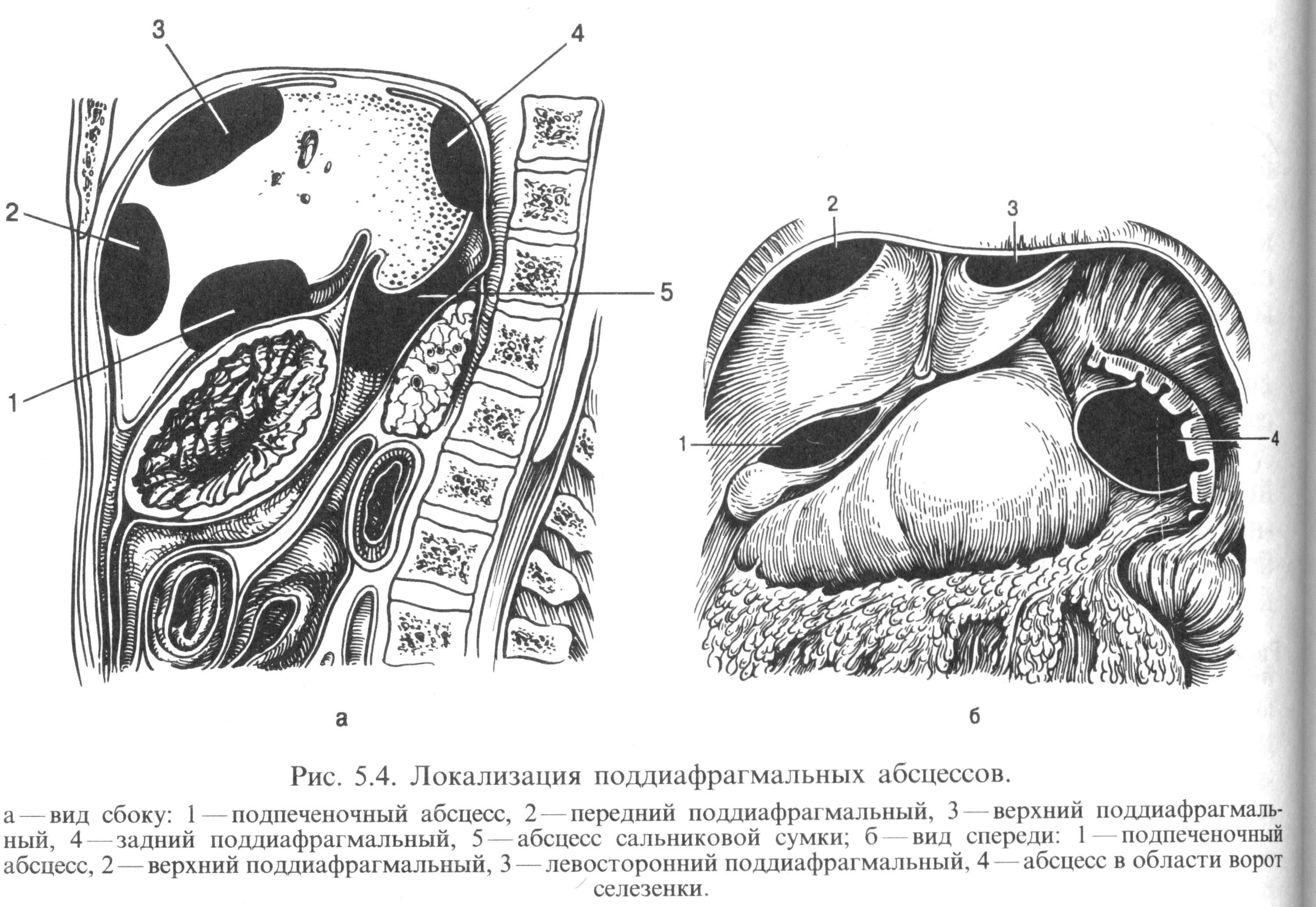 При передневерхней локализации абсцесс формируется. Сальниковая сумка кт анатомия. абсцесс сальниковой сумки кт. подпеченочный абсцесс кт.