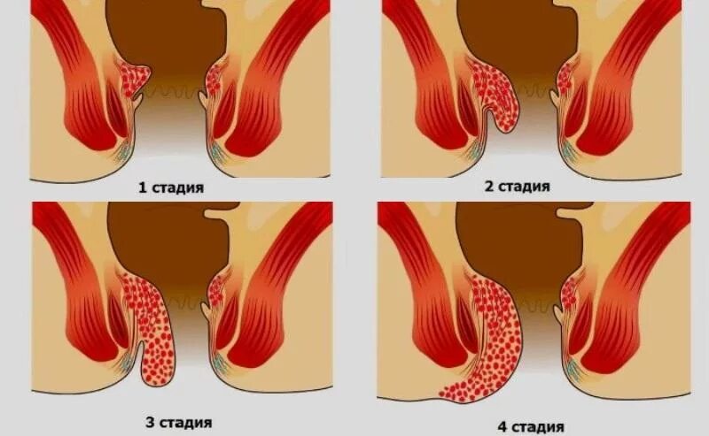 Колет в задний. Начальная стадия геморро. Начальная стадия геморроя. Острый внутренний геморрой. Геморрой на ранней стадии.