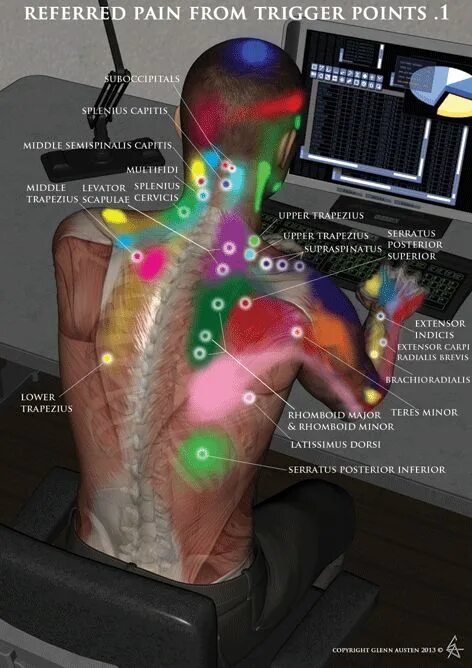 Триггерные точки это простыми словами. Триггерные точки. Триггерные зоны. Мышечный триггер. Триггеры мышц спины.
