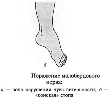 Невралгия малоберцового нерва
