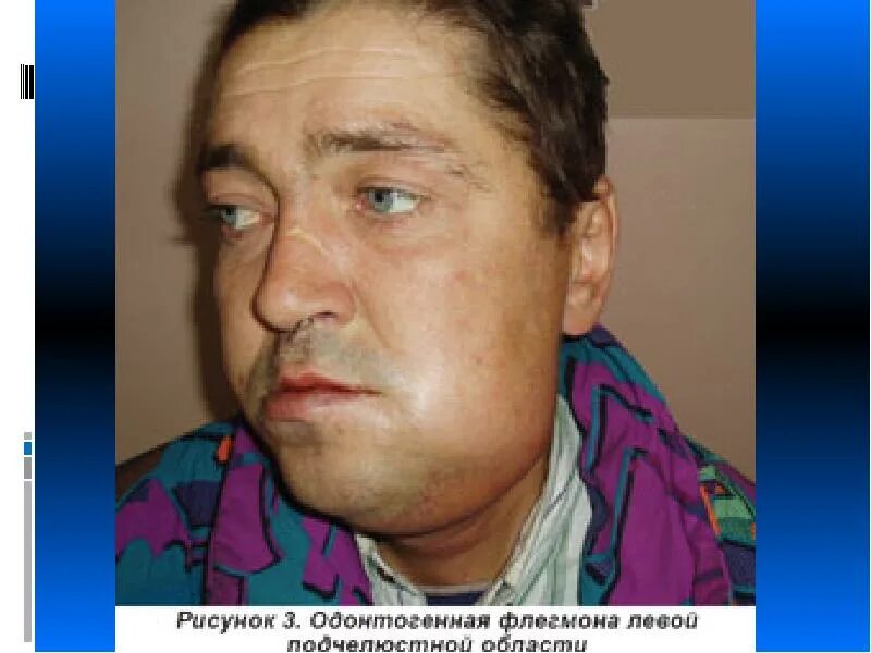 Флюс врача нет. Периостит челюсти (флюс). одонтогенный периостит. одонтогенная флегмона челюсти. одонтогенная флегмона поднижнечелюстной.