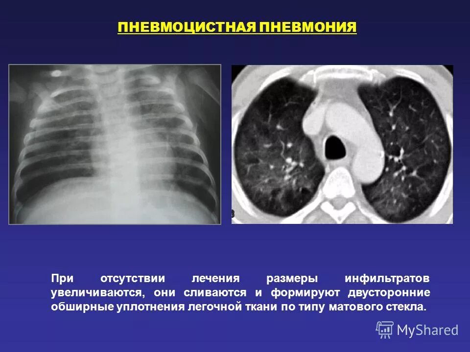 Легочный ткань по типу матового стекла. Затемнение по типу матового стекла. Экзогенный альвеолит кт. Уплотнение легочной ткани кт. Легочный ткань по типу матового стекла.