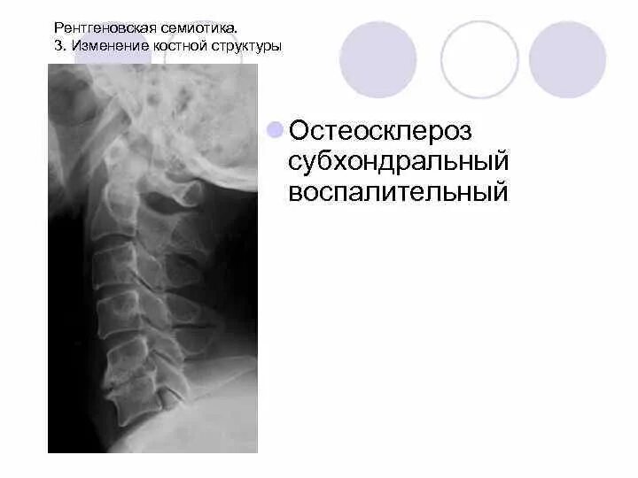 Остеосклероз позвоночника рентген. Рентгенологическая семиотика костной патологии. Остеосклероз замыкательных пластинок. Субхондральный остеосклероз позвонков.