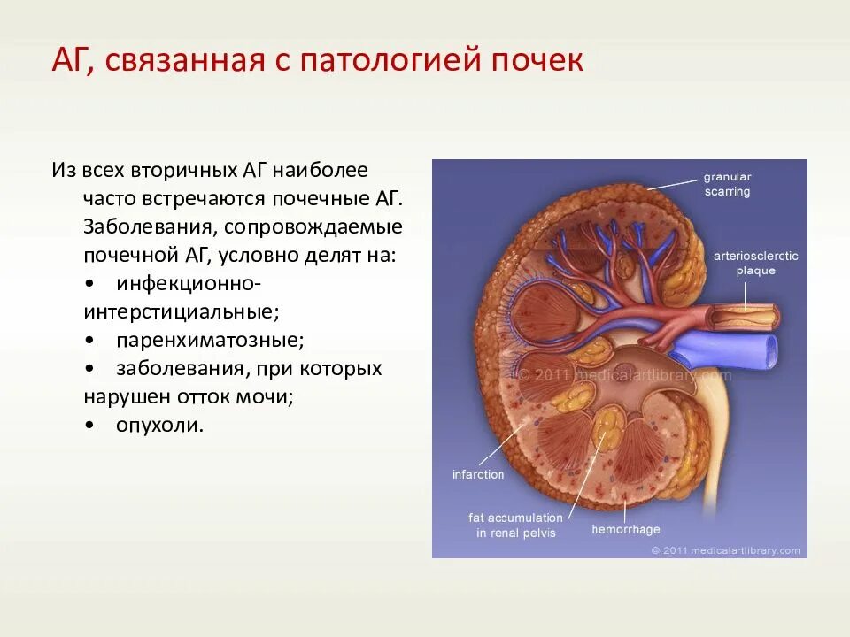 Почечная гипертония. Почечная аг. аг при паренхиматозных заболеваниях почек. аг при патологии почек.