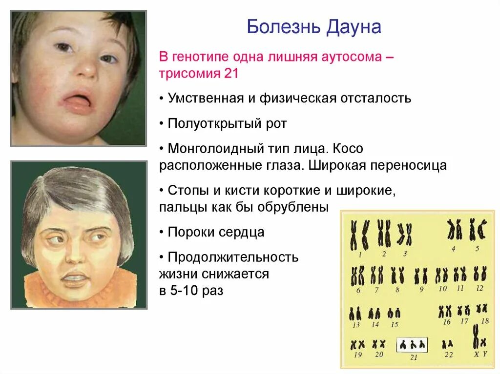 Болезнь дауна причины. Синдром Дауна Тип наследования генетика. Синдром Дауна трисомия 21 хромосомы. Болезнь Дауна Тип наследования. Синдром Дауна (трисомия по 21-Ой хромосоме);.
