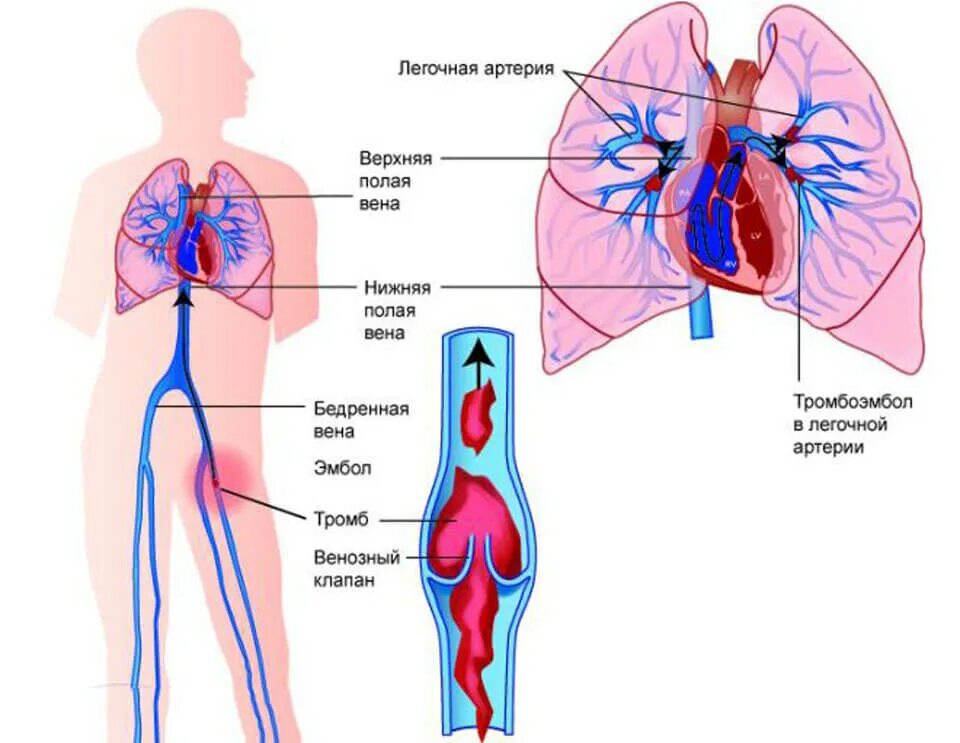 Тромб в легочной артерии. Тромбоэмболия легочной артерии. Тромбоэмболия легочной артерии осложнения. Легочная артерия и легочная Вена. Легкие артерии и вены
