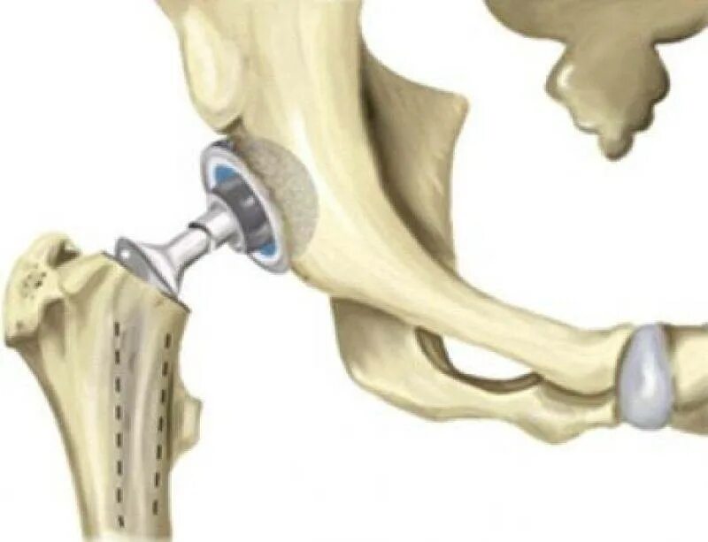 Сделать операцию шейки бедра. Перелом шейки бедра эндопротезирование тазобедренного сустава. Эндопротезы тазобедренного сустава Титан. Перелом шейки бедра протез. Реабилитация после эндопротезирования тазобедренного сустава (ТБС).