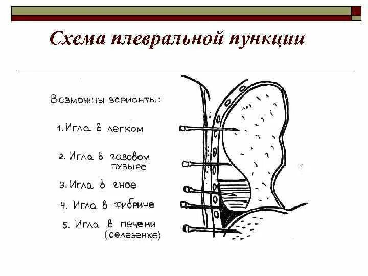 Техника выполнения плевральной пункции. Пункция плевральной полости схема. Схема пункции при гидротораксе. Диагностическая плевральная пункция алгоритм.