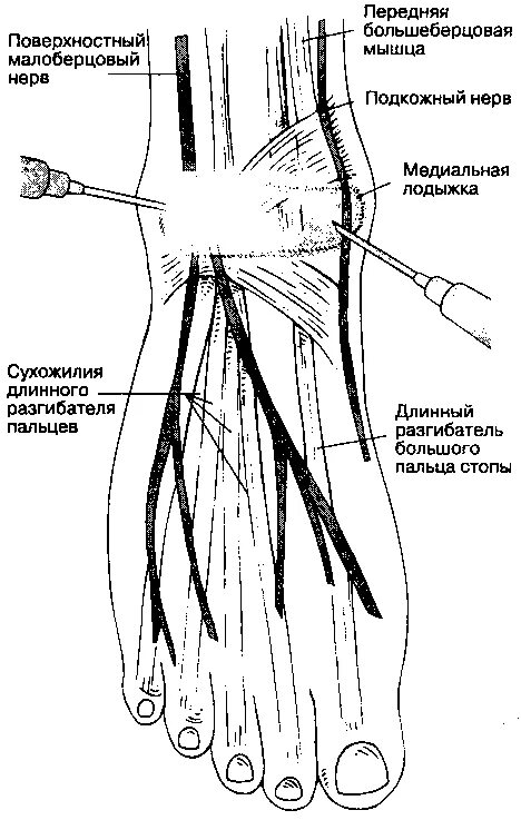 Проводниковая анестезия стопы методика. Медиальный малоберцовый нерв. Малоберцовый нерв иннервация кожи. Блокада большеберцового нерва техника. Большеберцовая нейропатия